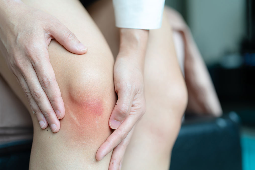 Gelenkblutung im Knie Gelenkblutung im Knie